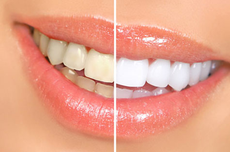 برای سفید کردن دندان‌هایتان، اصرار نکنید!