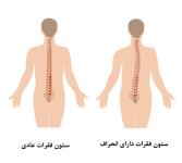 انحراف ستون فقرات