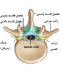 پیشگیری و درمان دیسک کمر