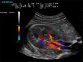 سونوگرافی داپلر در بارداری