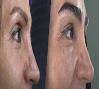 کاشت مو و ابرو با پرداخت 8 تومن و قسطی