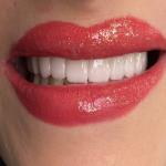 ایمپلنت ارزان در تهران  | دندانپزشکی میلان